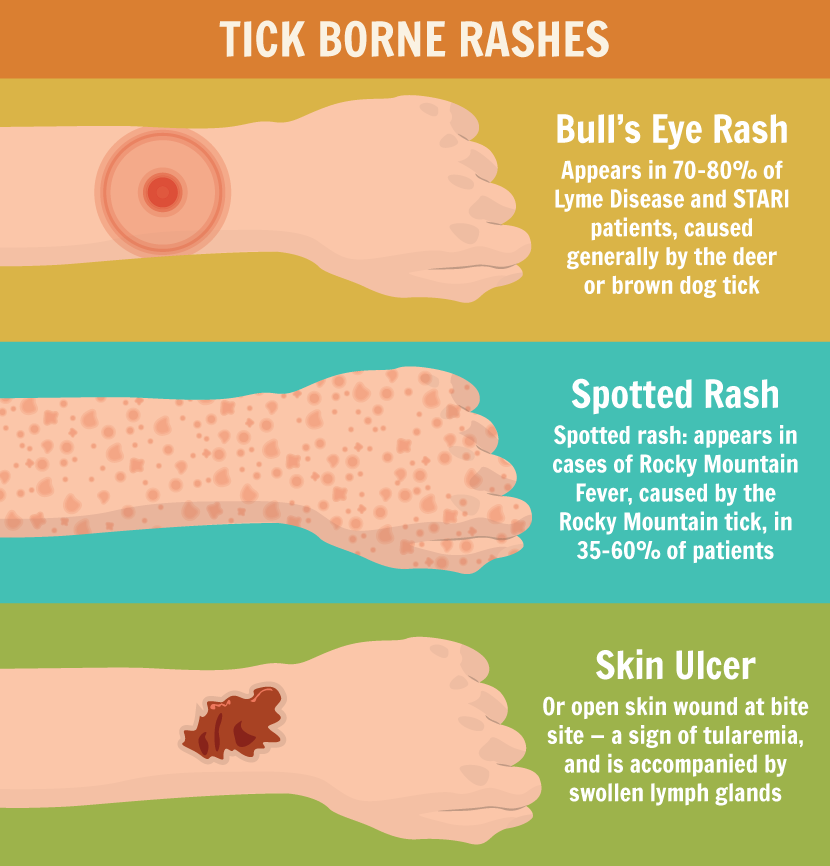 infographic on several types of rashes associated with tick-borne diseases