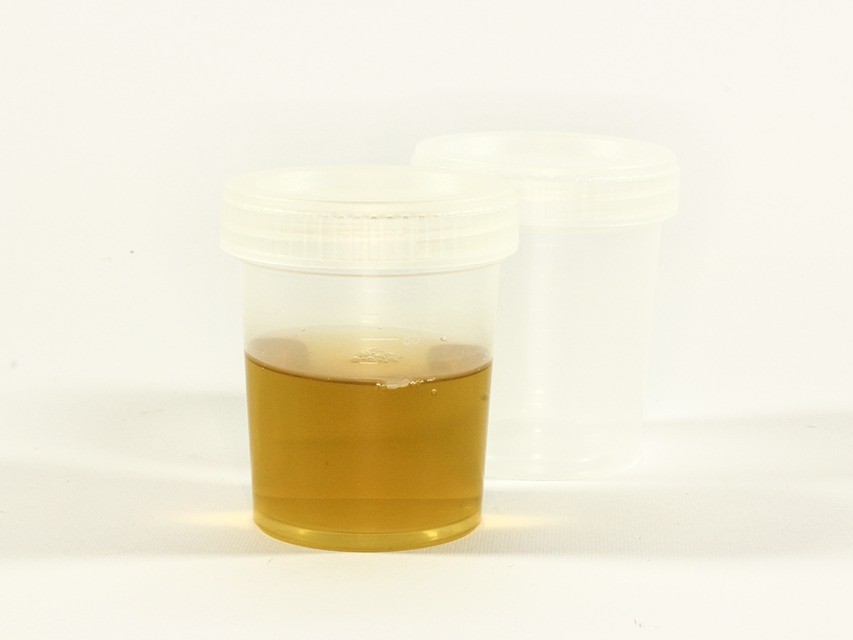 Sample cup of urine