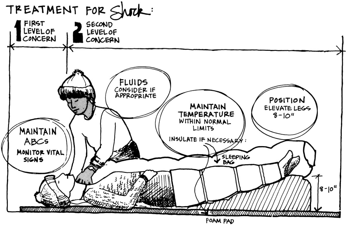 Diagram of a patient with elevated legs in shock position