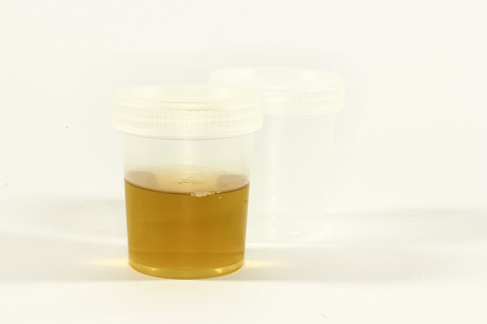 Container with a urine sample
