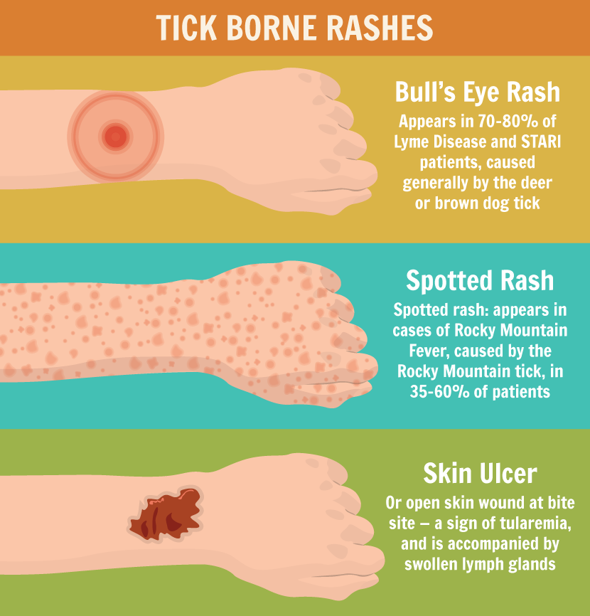 How To Prevent And Manage Tick Bites Infographic   Tick Borne Rashes 1 